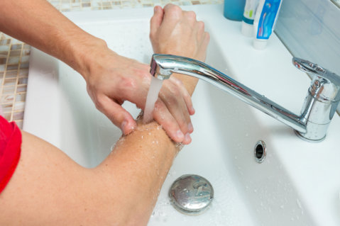 Precautionary Measures When Treating Burns