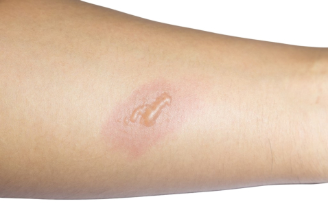 How to Properly Treat First-Degree Burns by Yourself